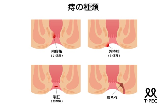 痔の種類